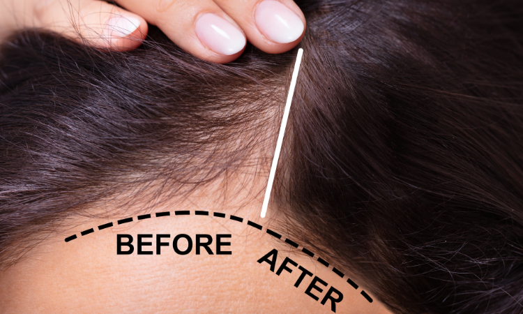 Hair Loss Treatment in Washington