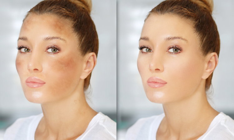 Melasma Treatment in Arlington