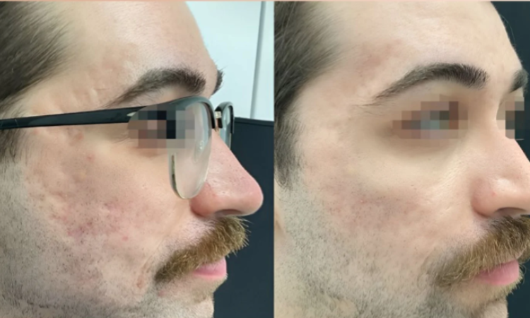 Korean glass skin treatment