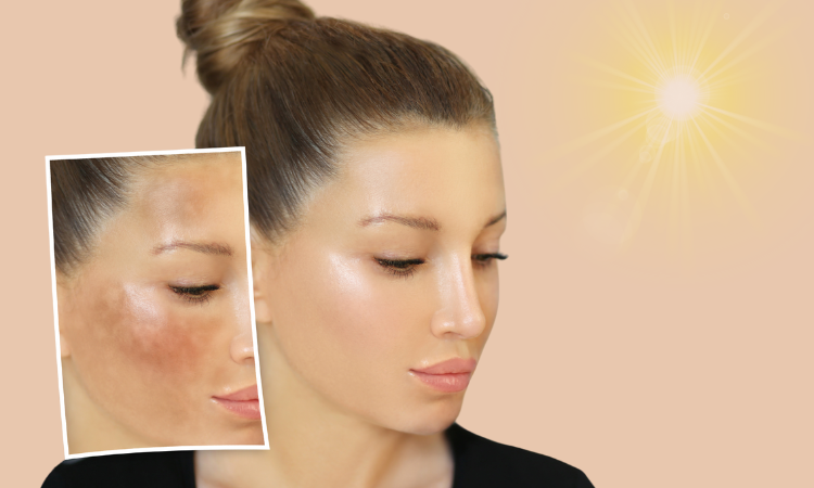 Pigmentation Treatment in DMV