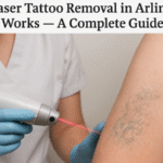 Laser Tattoo Removal in Arlington