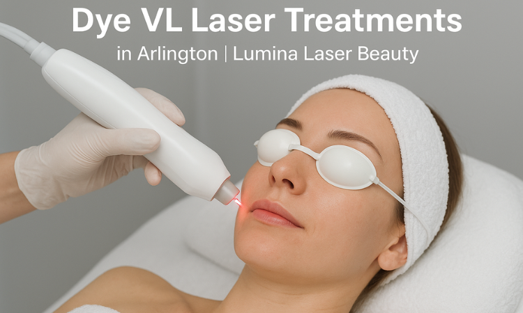 Dye VL Laser Treatments in Arlington